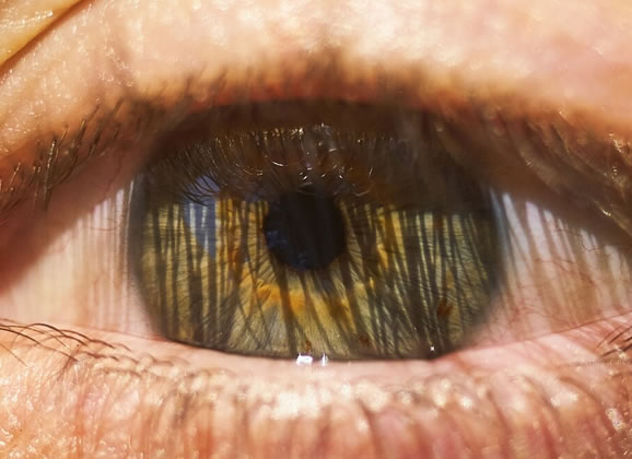 ojo-seco-1 Ojo miope